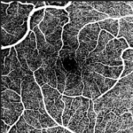 Uso de la inteligencia Artificial como Herramienta Clínica para Predecir la Aparición de Retinopatía Diabética Mediante el Uso de Imágenes de Tomografía de Coherencia Óptica (OCT) y Angiografía por Tomografía de Coherencia Óptica (OCTA).